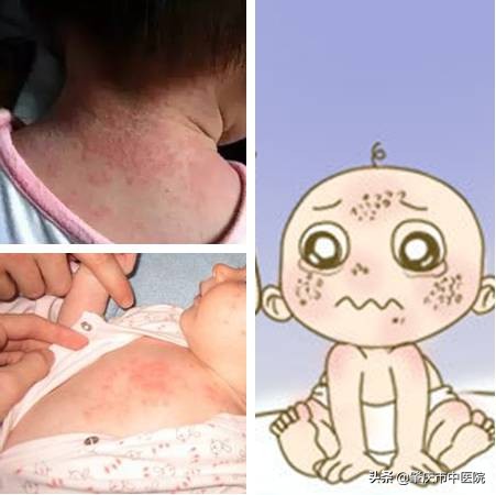 解读八种夏天易发皮肤病,3种秋季高发皮肤病