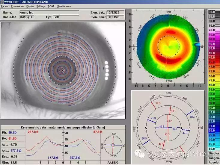 如何选择角膜塑形镜的品牌,怎么选角膜塑形镜的参数