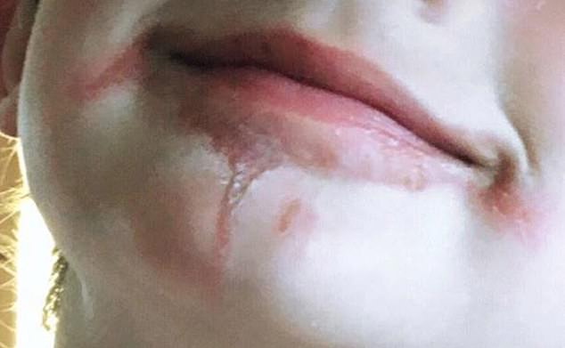 阳光下吃柑橙冰棍或冷饮，医生提醒，可能引起孩子植物阳光皮炎