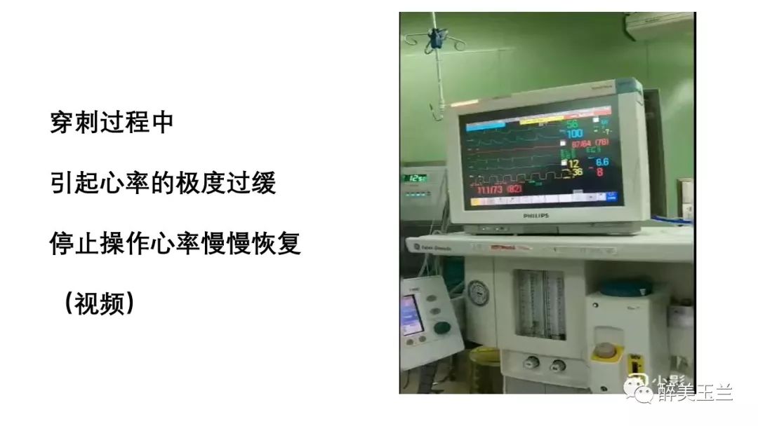 病例分享丨三叉神经节微球囊压迫术的麻醉管理