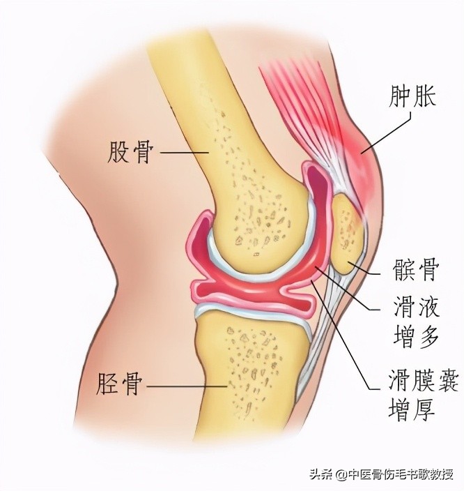 膝盖疼滑膜炎治疗方法是什么,膝盖滑膜炎疼痛用什么药疗效最好