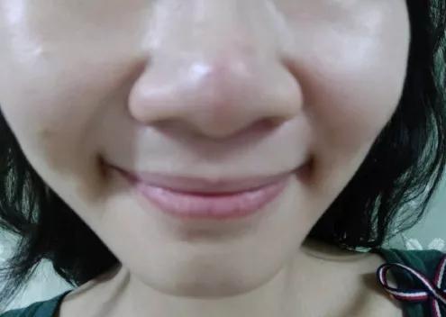 蒜头鼻的改变,蒜头鼻变挺的方法