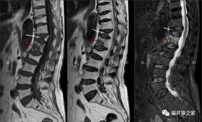 腰椎有哪些病变,腰椎病变有几种
