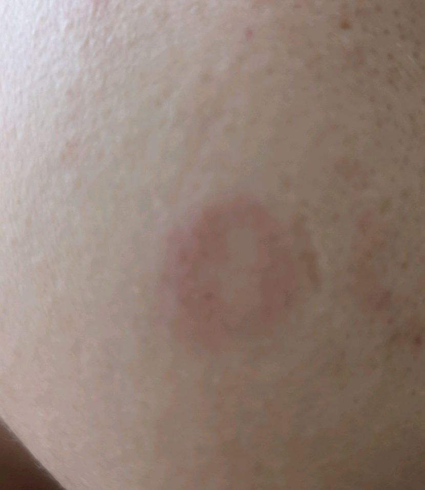 脸上有大的圆圈空心状红斑图,脸上圆圈状红斑