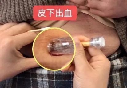 打皮下针拔针出血怎么办,皮下注射有回血继续注射会死吗