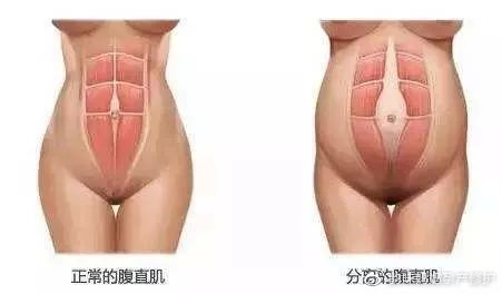 产后肚子松去恢复中心起作用吗,产后妈妈肚子的恢复方法