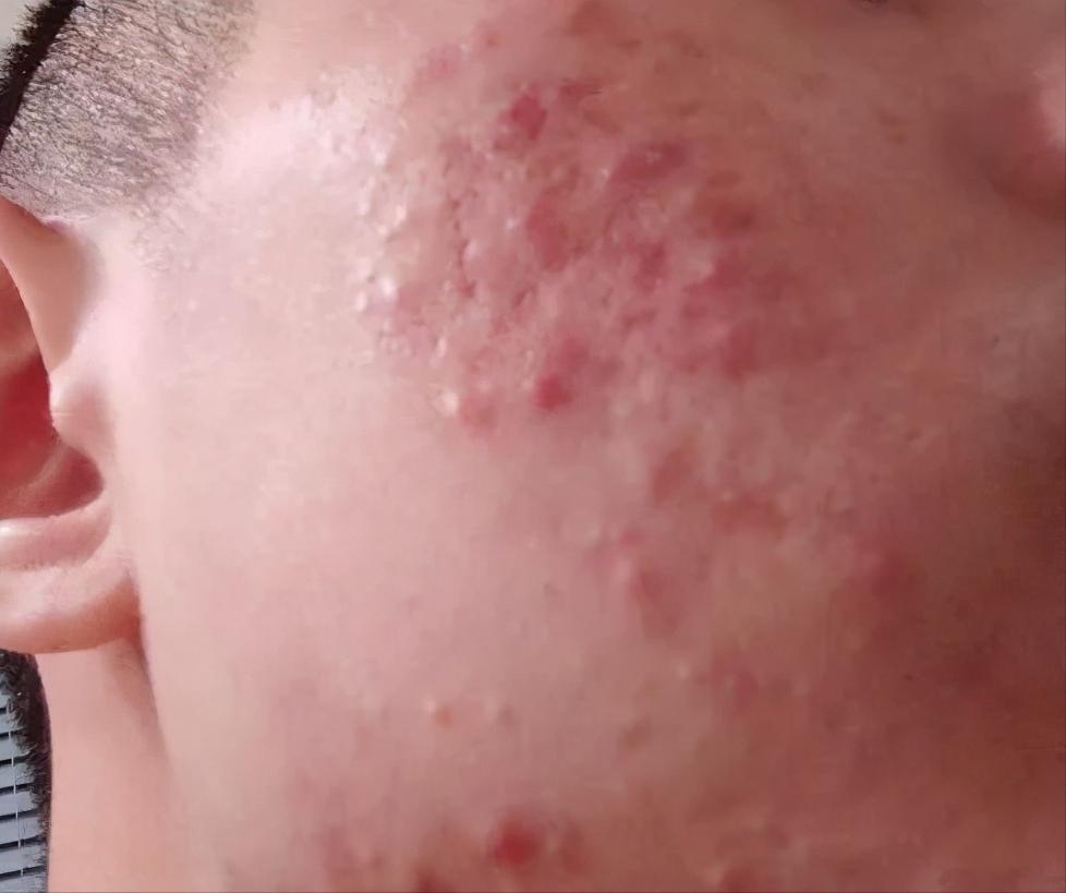 清理严重粉刺痘痘,严重的痘痘去除视频