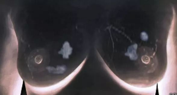 哺乳的女人为什么不容易患乳腺癌,哺乳期乳腺癌的征兆有哪些呢