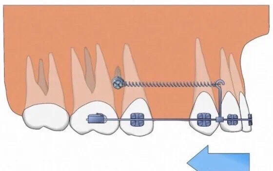 矫正牙齿在牙龈打钉子多久能取,整牙一定要在牙龈里打钉子吗