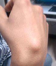 腱鞘囊肿怎么办,腱鞘囊肿用什么药膏