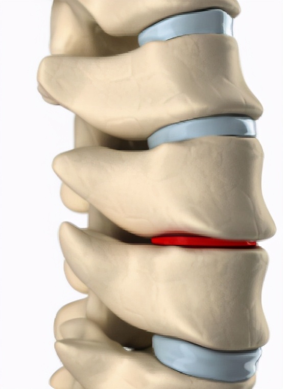 腰椎间盘突出膨出怎样锻炼恢复,颈椎腰椎间盘突出锻炼最好方法