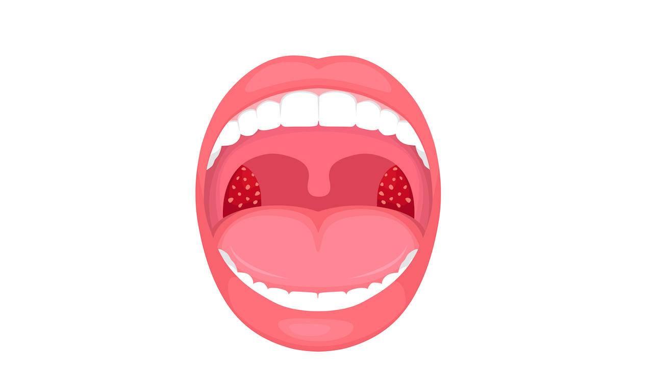 儿童扁桃体炎怎么治疗彻底痊愈,病毒急性扁桃体炎怎么治疗最快