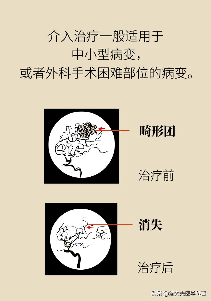 脑血管畸形在哪些部位比较严重,先天性脑血管畸形可以治愈吗