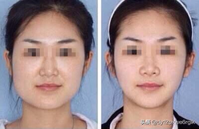 如何改善大小脸,怎样改善脸不对称大小眼