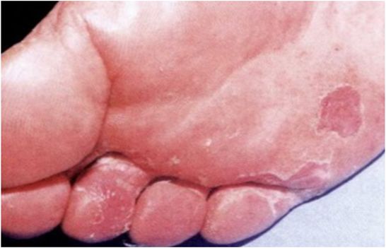 癣痒痒怎么办,癣痒怎么快速止痒