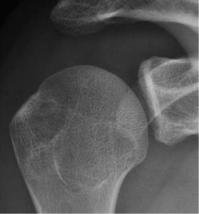 肩关节评定量表cms,肩关节功能评估法cms