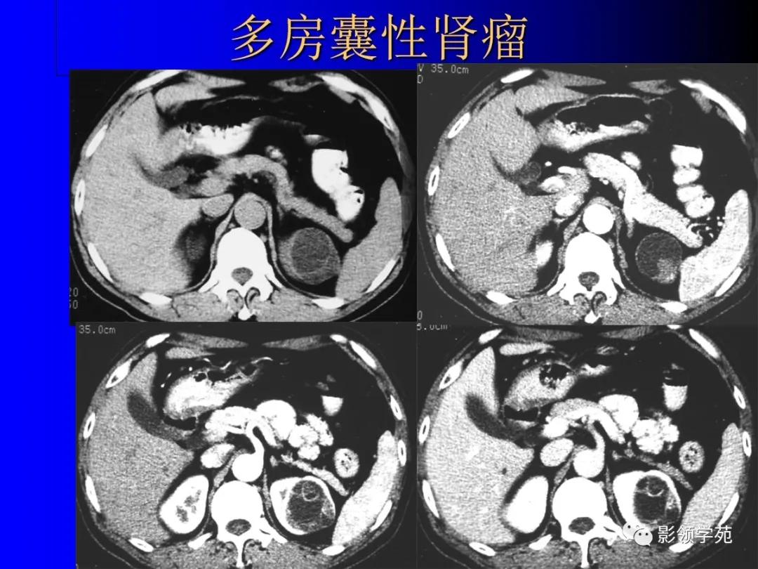 肾脏囊性肿块的影像学特点,肾脏典型病理图片及解析