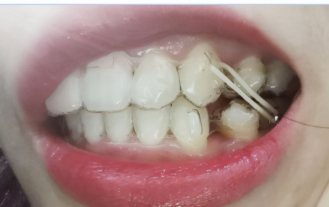 杭州牙齿龅牙矫正,牙齿矫正记录隐适美