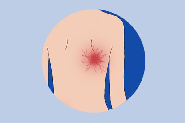 红痣痒越来越多怎么回事,身体长红痣不疼不痒什么原因