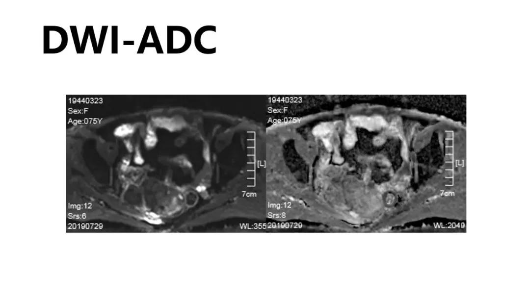 卵巢原发肿瘤的分析思路
