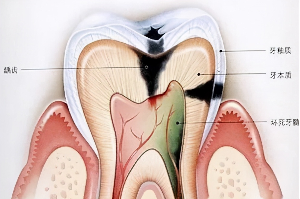 牙痛神经发炎,牙痛到什么程度需要抽牙神经