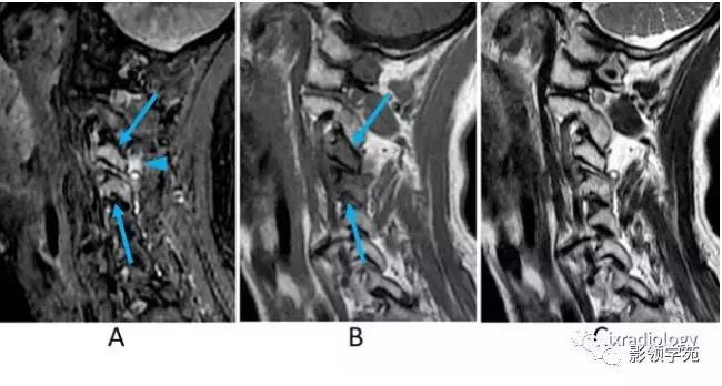 9种椎体和椎旁信号增高的非肿瘤性病变