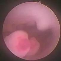 多年不孕容易长子宫肌瘤,多年不孕怎么找原因