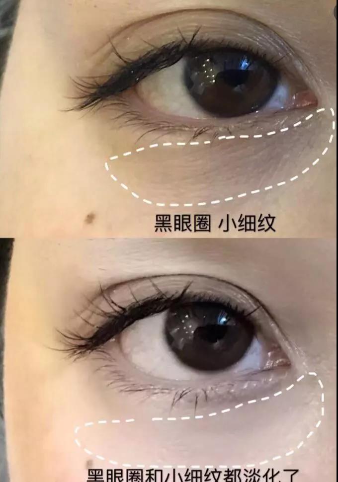 眼袋眼纹黑眼圈改善方法,去黑眼圈眼袋眼纹最有效的小妙招