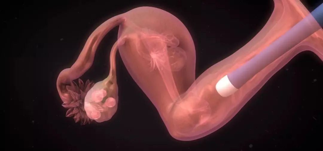 月经量少和流产刮宫有关系吗,月经量少和流产有关吗