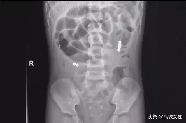 8岁男孩误吞5厘米钢钉,惊险9岁男孩误吞3厘米图钉