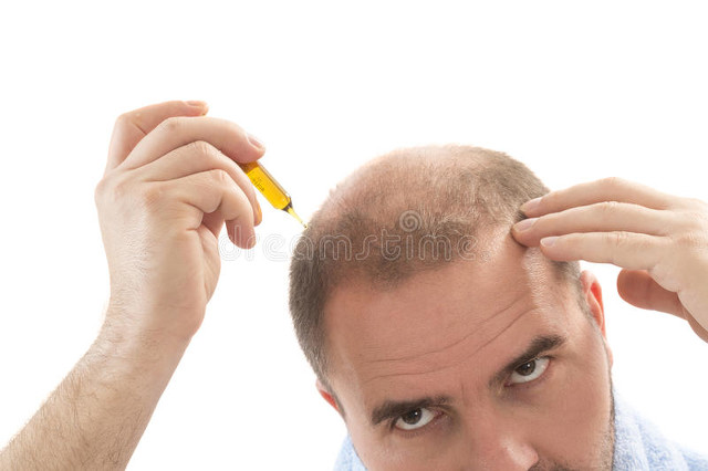 什么是斑秃怎么治用什么药,什么是斑秃如何防治