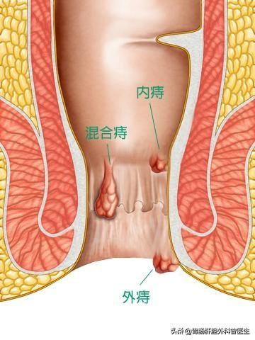 怎么样预防痔疮引起的大便出血,痔疮的预防与治疗新进展