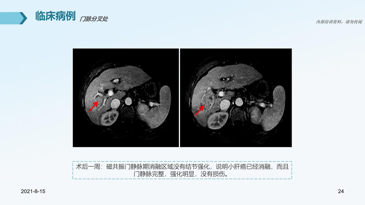 氩氦刀适合早期的肿瘤的切除么,氩氦刀肿瘤治疗新方法