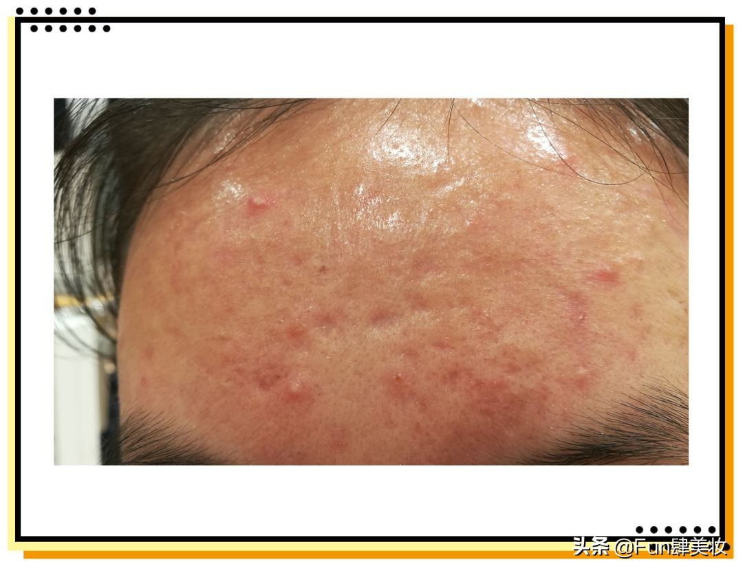 红痘印和红痘痘怎么祛,祛痘疤痘印痘坑最有效的方法