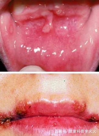 关于口腔溃疡，你想了解的都在这里了！