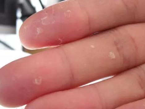 季节性手脱皮是缺乏哪种维生素,一到夏天手就脱皮是缺钙吗
