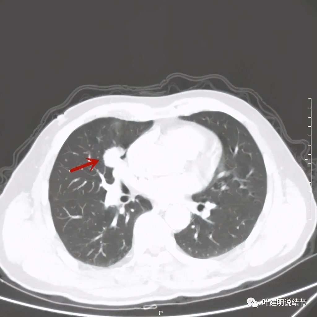 实性结节影要不要紧,实性结节穿刺活检为良性
