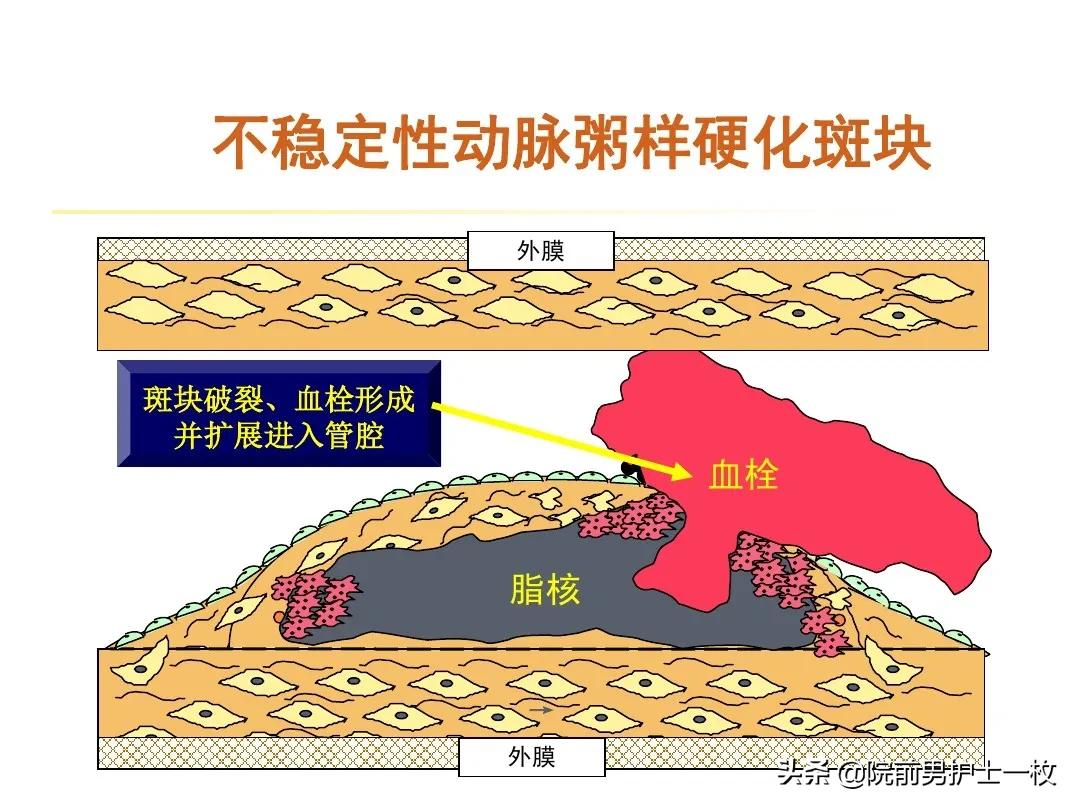 急性心梗的紧急处理视频,一旦发现急性心梗如何救