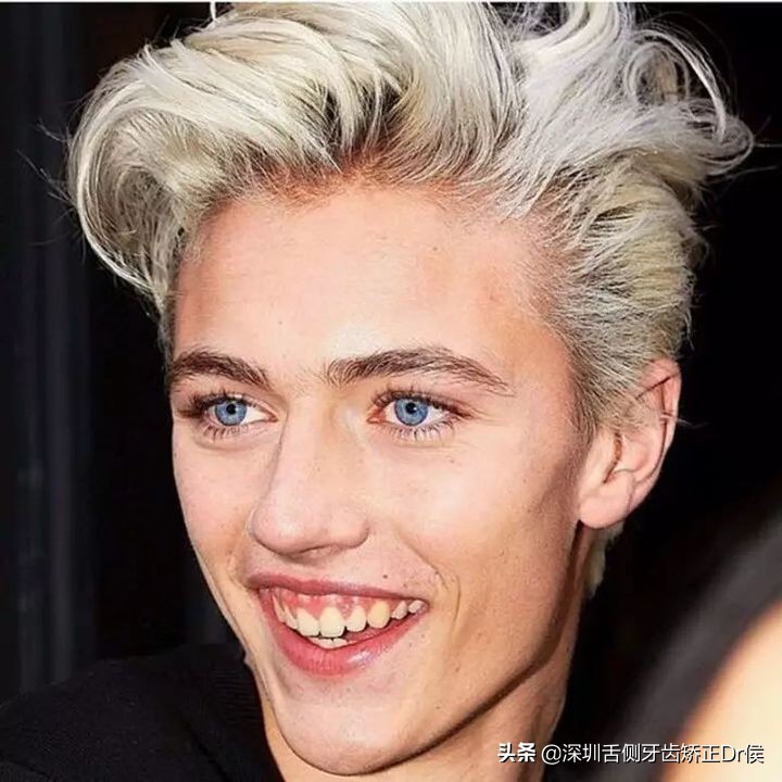 露龈笑怎么办,露龈笑矫正