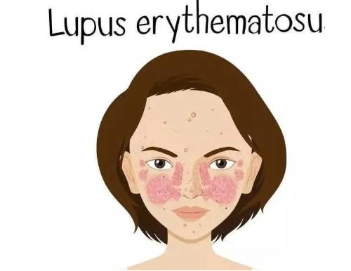 系统性红斑狼疮治疗新突破,战狼红斑狼疮