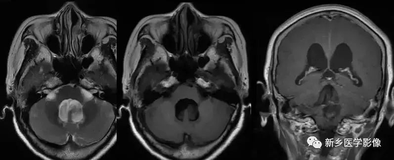 脑室影像学表现,脑室占位影像