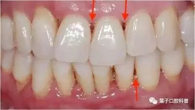 为什么吃东西会把牙磕掉,为什么吃东西后会牙齿出血呢