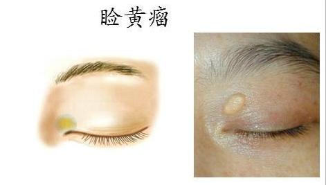 眼皮上有小疙瘩和心脏病有关系吗,心脏有问题眼皮会长什么