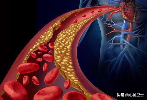 心血管疾病膳食营养防治,心血管病饮食应怎样