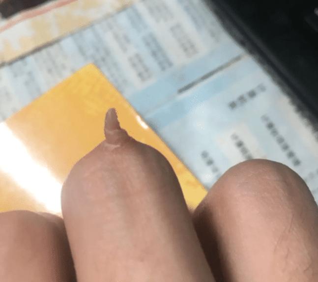 中指长了一个肉球,中指肉掉了一块还能长出来吗