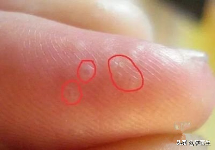 以前没有汗疱疹怎么突然就得了,汗疱疹会截肢吗