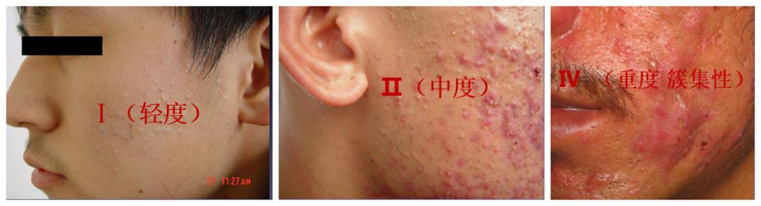 战“痘”系列之三：轻度*疮痤**的治疗