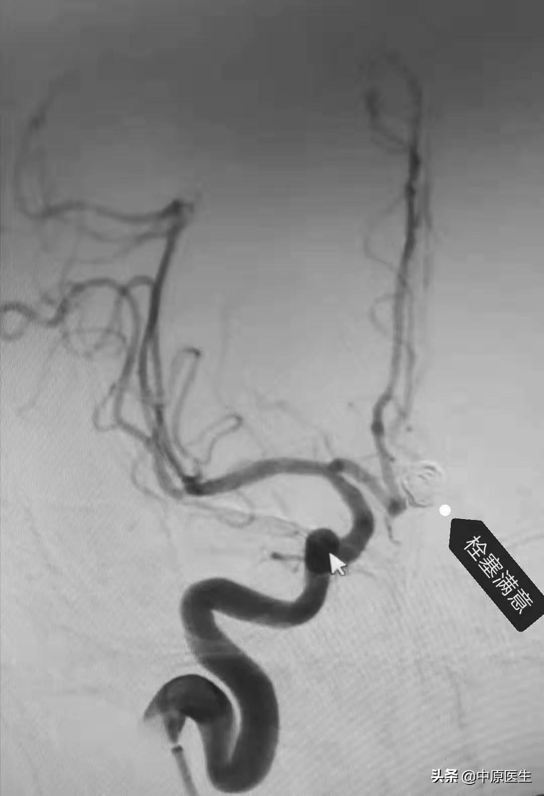 大脑双侧动脉瘤,发现脑内有两个瘤医生说不管