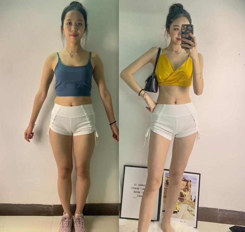 女性腰腹吸脂手术全过程,肥胖的人可以吸脂减肥吗