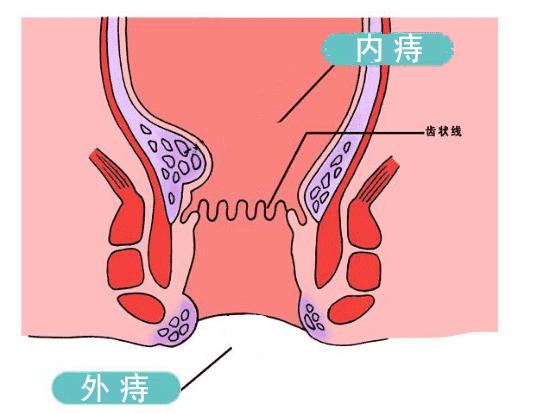 河北省中医院肛肠科痔疮手术,广安门中医院肛肠科痔疮手术